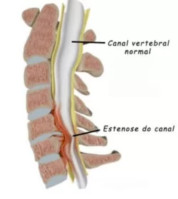  ilustração de uma comparação entre um canal vertebral normal e uma estenose